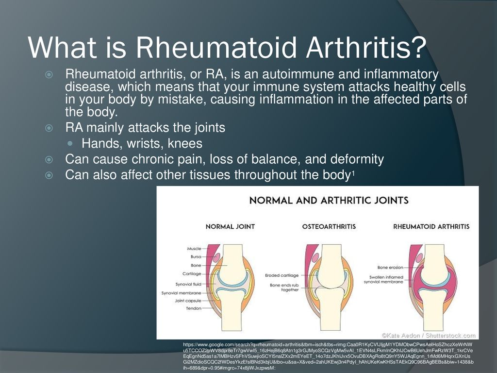 rheumatoid arthritis 2. szakasz)